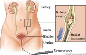 Trattamento Calcoli Urinari, Trattamento Endoscopico Mini-Invasivo dei Calcoli Urinari